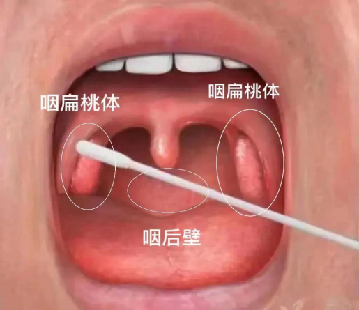 口咽拭子的取样部位