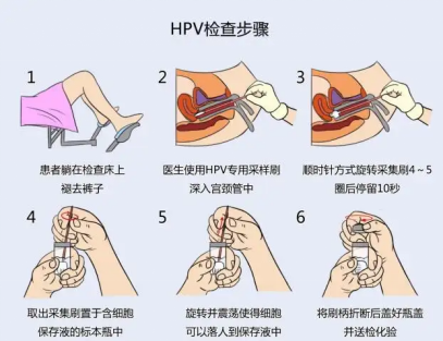 传统HPV检查取样方法.png